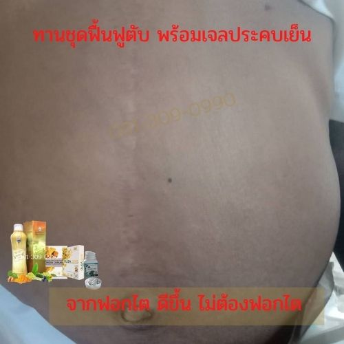 โรคตับ