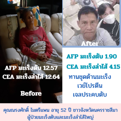 รีวิวผู้ป่วยโรคตับแข็ง