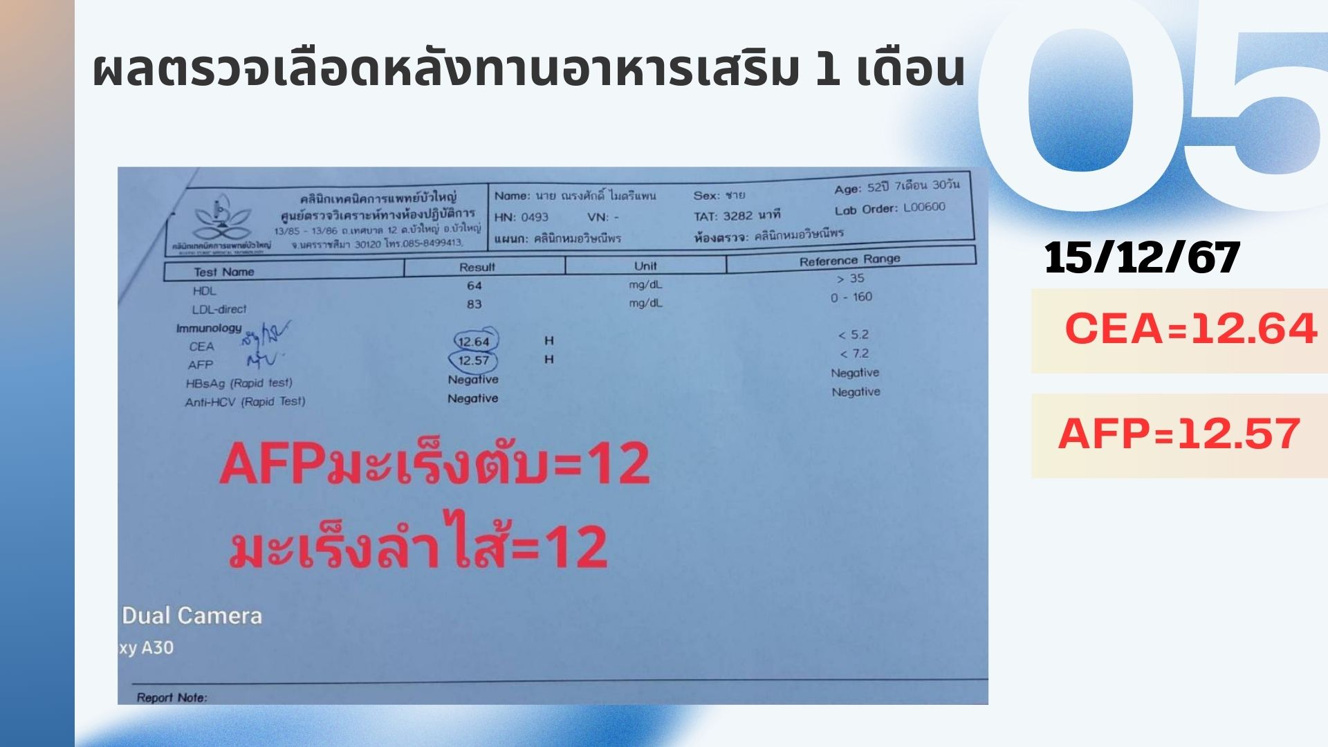 รีวิวผู้ป่วยโรคตับแข็ง